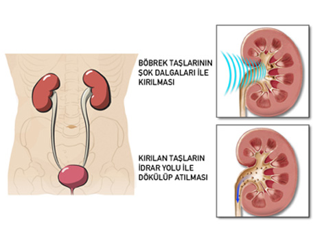 PNL Tedavisi - Prof. Dr. Haluk Akpınar