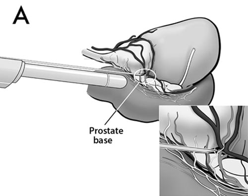 Prostat Biyopsisi - Prof. Dr. Haluk Akpınar