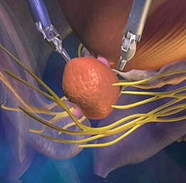 prostatektomi_03.png
