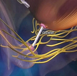 prostatektomi_05.png