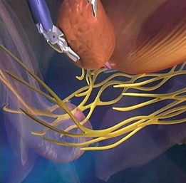 prostatektomi_4.jpg